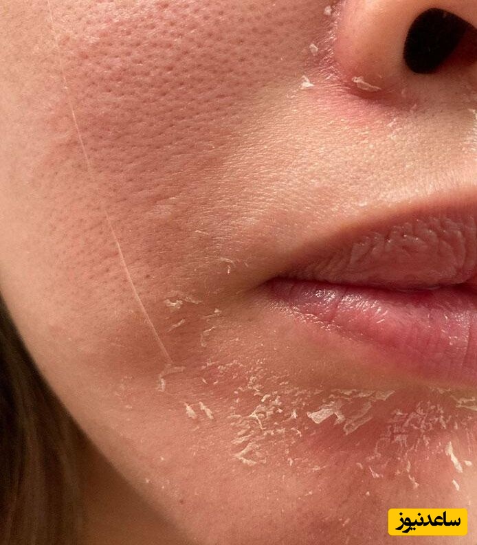 از علت تا درمان پوسته پوسته شدن صورت