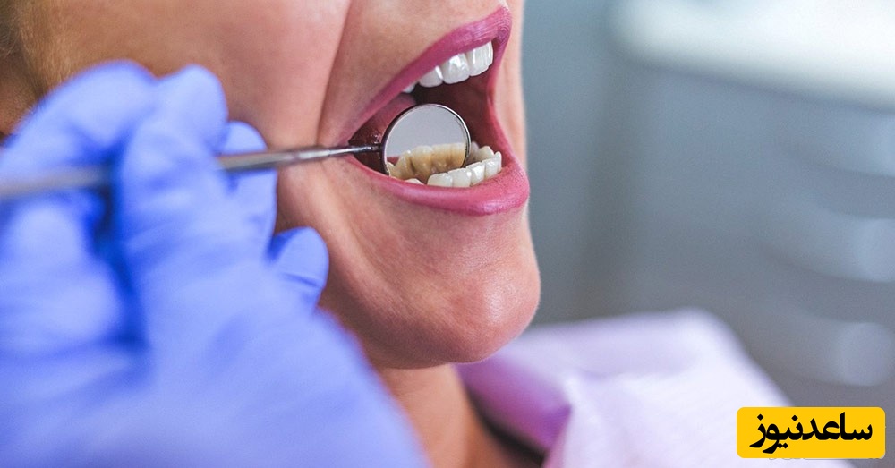 سیاه شدن بین دو دندان و نکات مهم در مورد آن