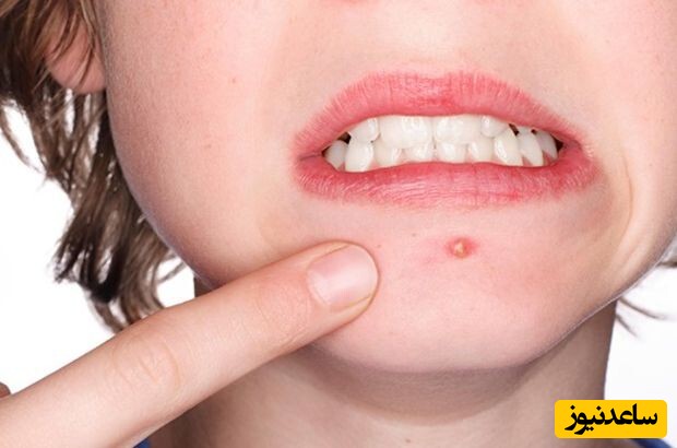 دیدن چرک در خواب چه تعبیری دارد؟ / تعبیر خواب چرک