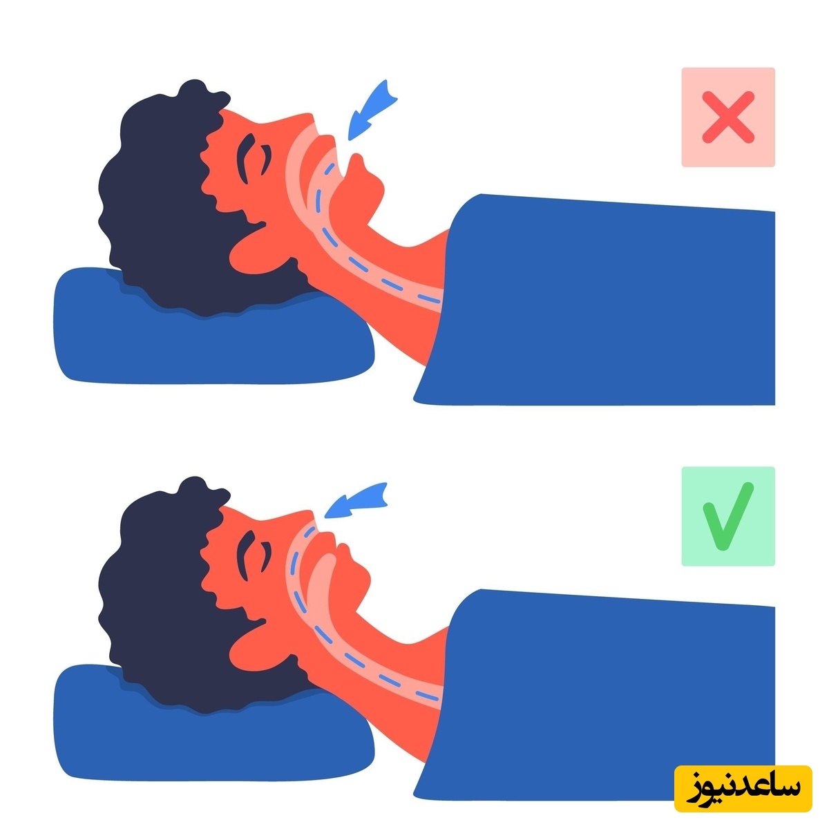 رایج ترین دلایل تنفس از طریق دهان و درمان آن