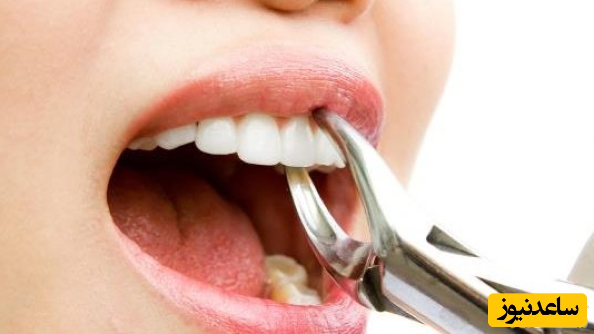 اگر دندان اضافی دارید بخوانید!