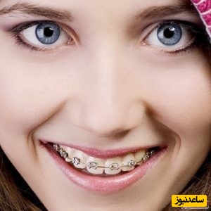 ارتودنسی بعد از عمل بینی یا قبل از آن؟