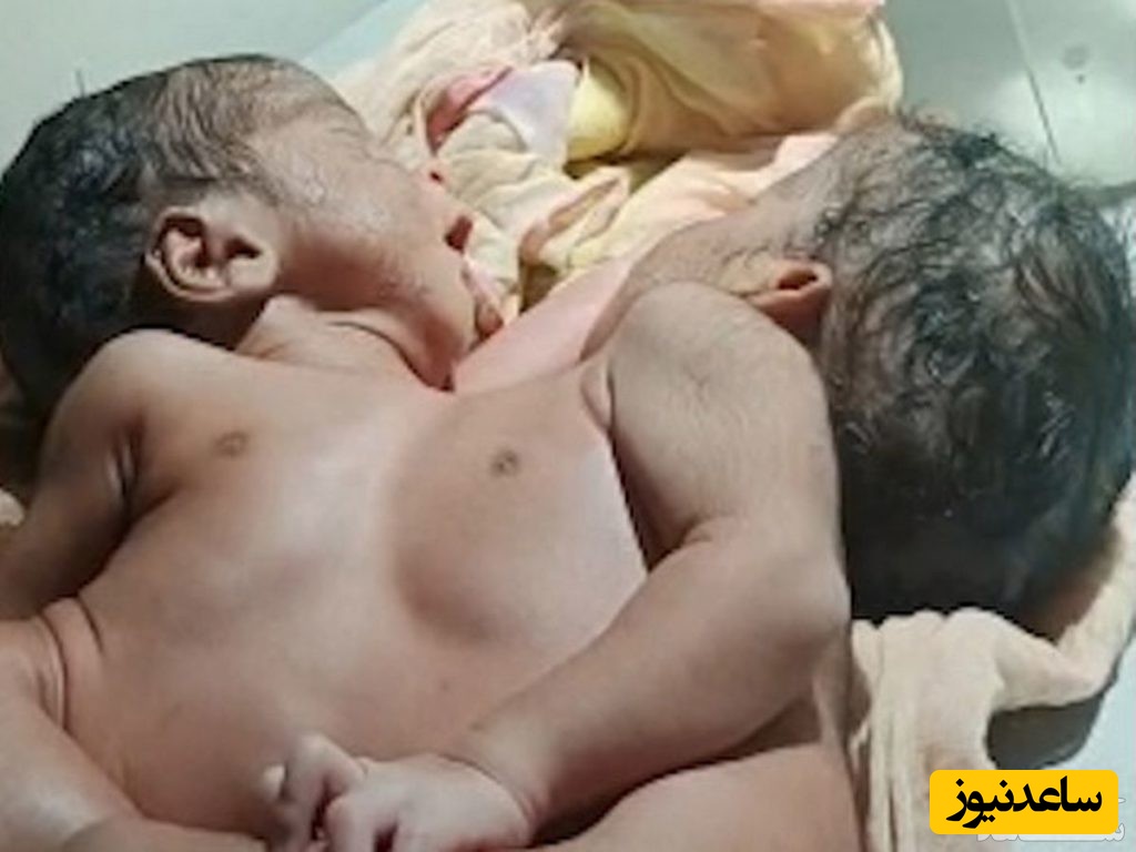 تولد دوقلوهای عجیب به هم چسبیده از ناحیه قفسه سینه + عکس