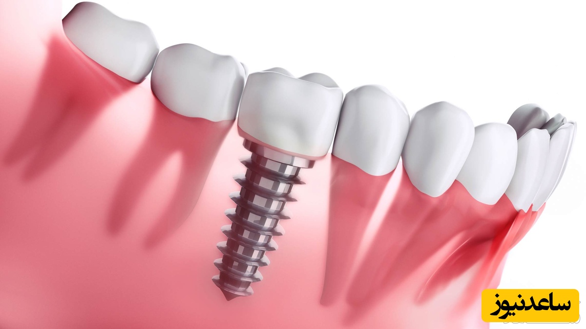 نکات مهم درباره ایمپلنت دندان که باید بدانید!