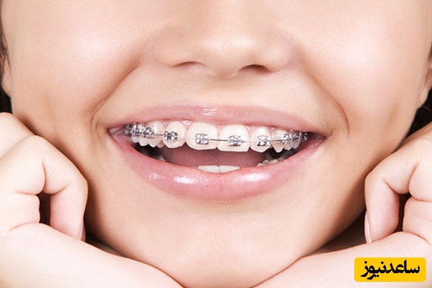 برای ارتودنسی در بارداری چه احتیاط‌هایی باید کرد؟