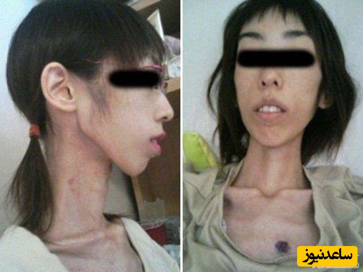 شکنجه عجیب دختر ژاپنی و کاهش وزن وی؛ دختر 20 ساله با وزن 17 کیلوگرم!