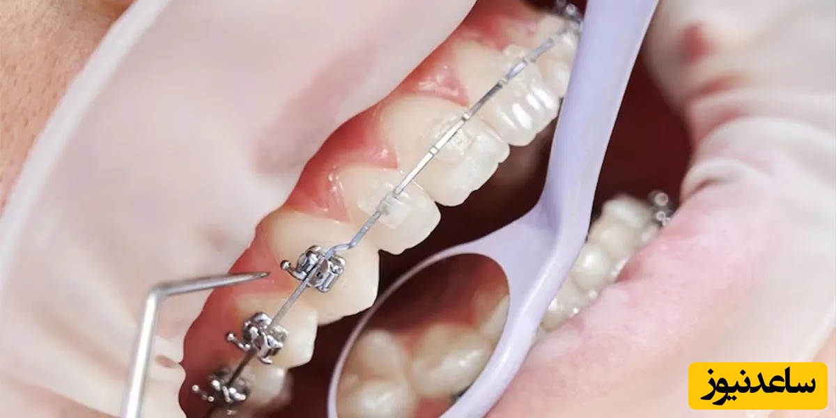 اجزای مهم ارتودنسی ثابت دو فک چیست؟