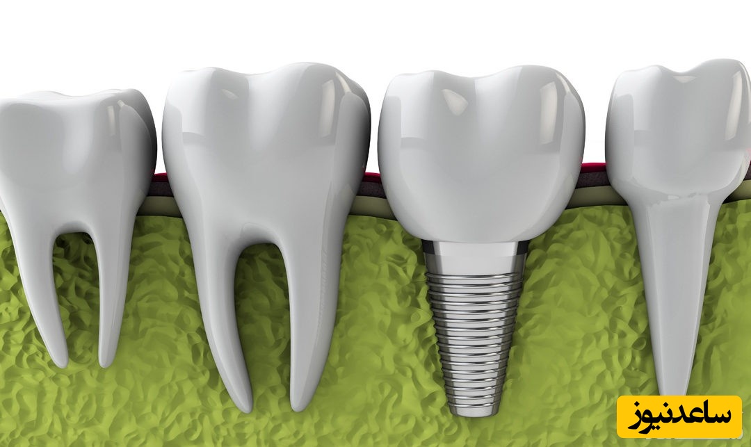 معایب ایمپلنت دندان چیست؟