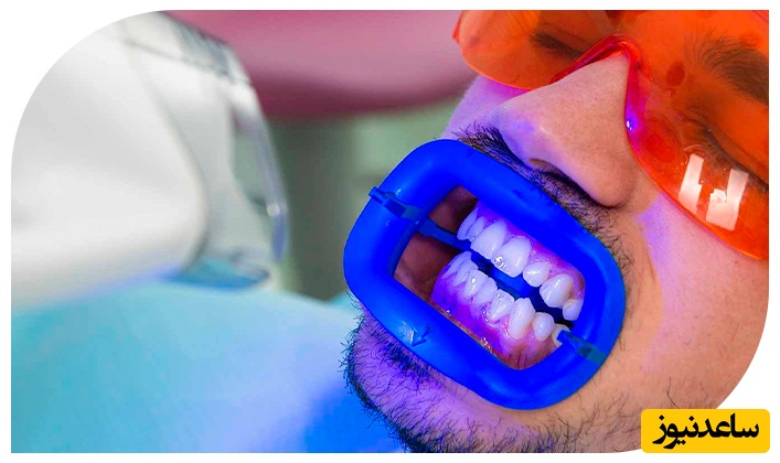 سفید کردن دندان ها با کمترین عارضه!