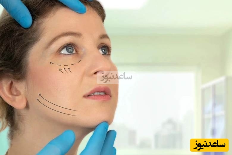 زاویه سازی فک با هایفو چیست؟