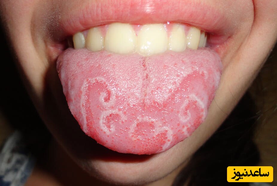 7 درمان خانگی معجزه‌آسا برای زبان جغرافیایی