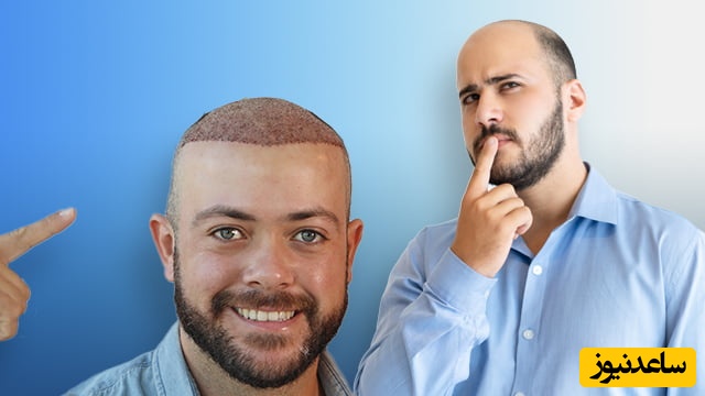 مزایا و محدودیت‌های هر روش کاشت مو در مردان