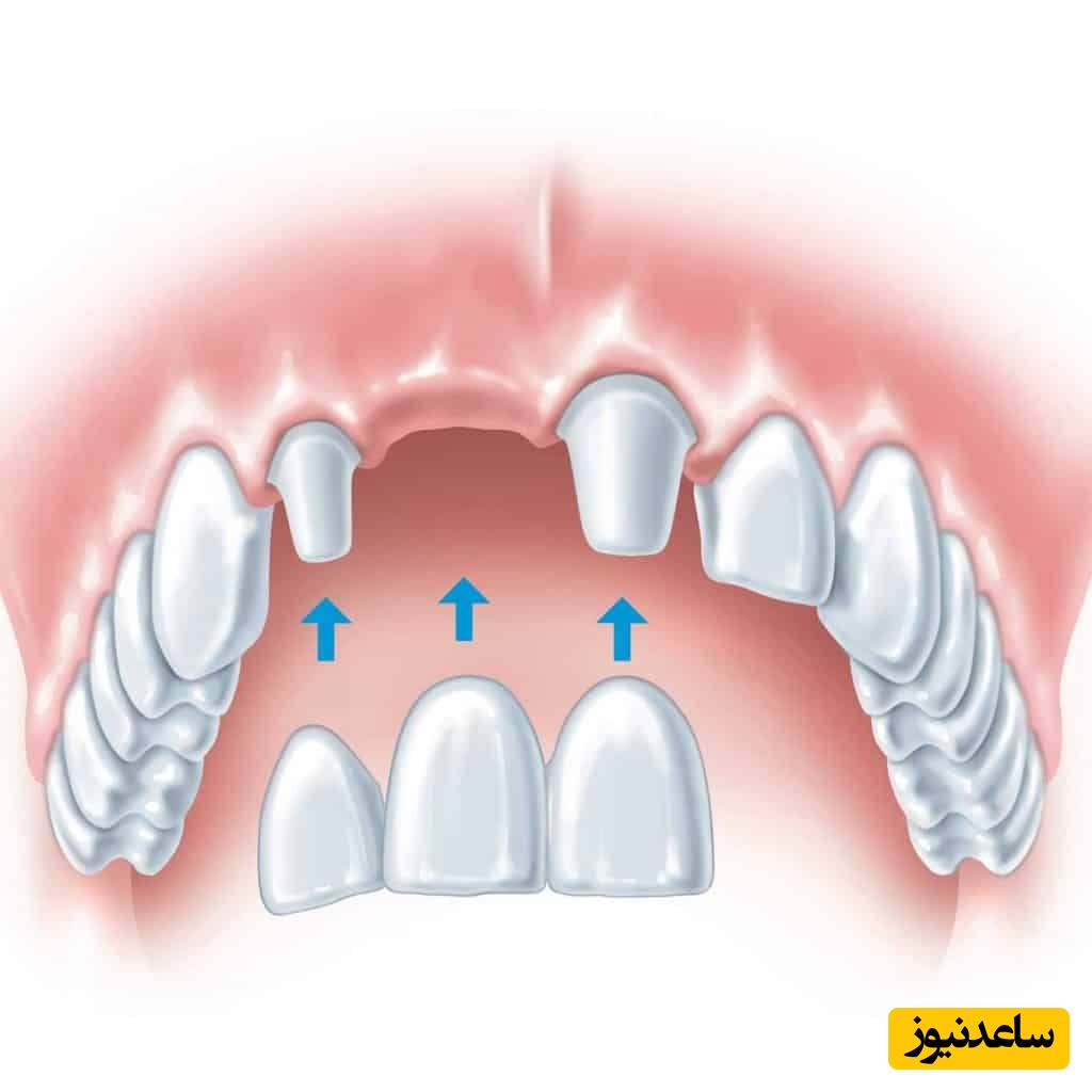 انواع بریج دندان