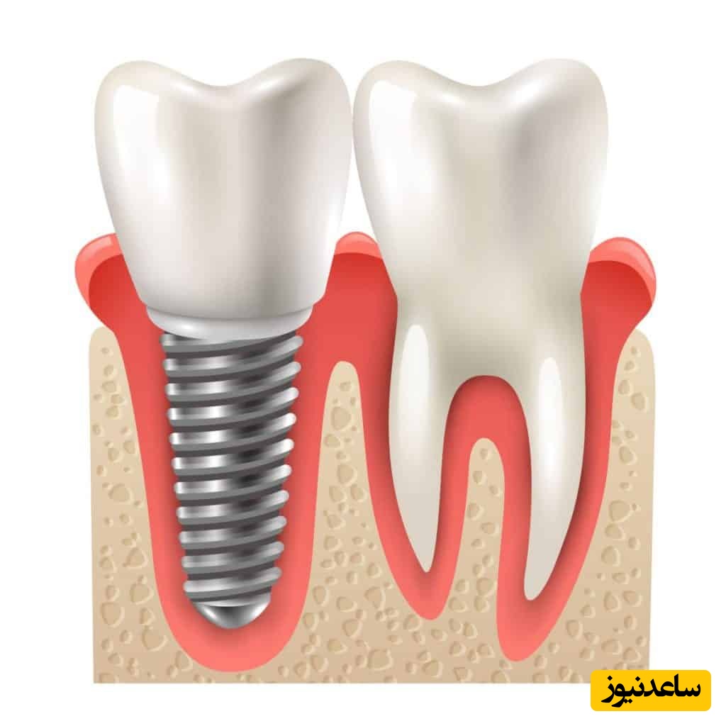 قالب گیری ایمپلنت دندان