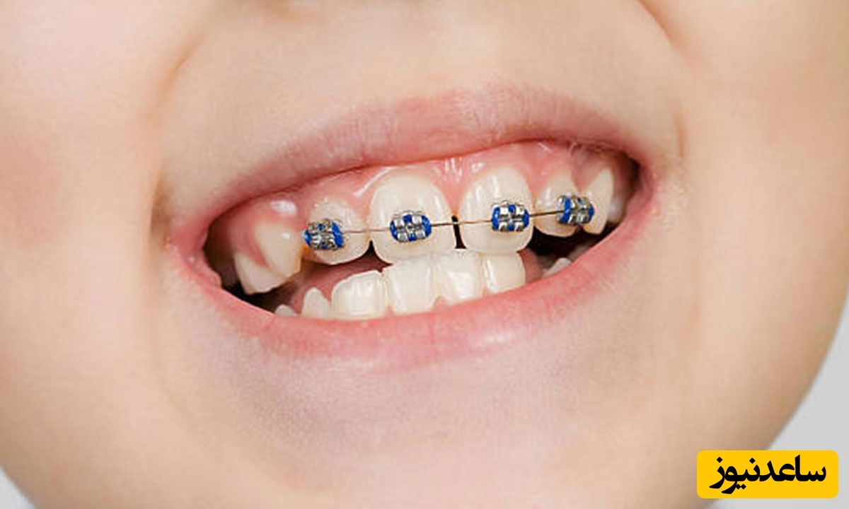 مراحل انجام ارتودنسی کودکان چیست؟