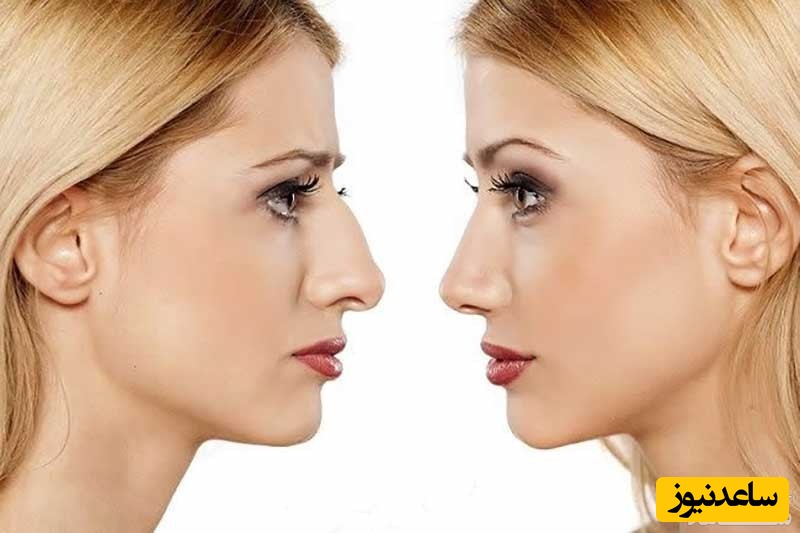 هرآنچه باید درباره جوش بعد از عمل بینی و علل آن بدانید