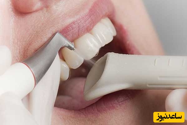 روش‌های درمان لکه‌های دندانی
