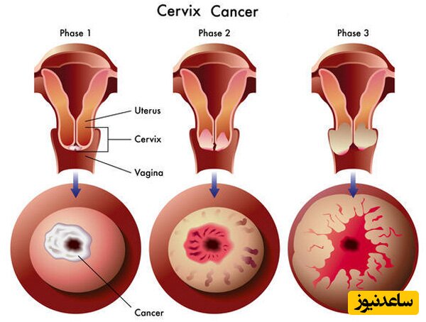سرطان دهانه رحم