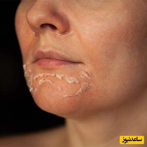 علت‌های اصلی پوسته پوسته شدن پوست صورت کدامند؟