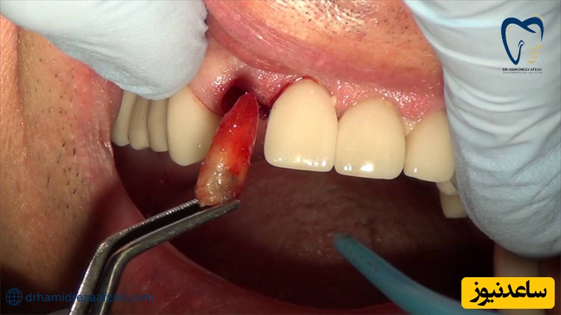 کشیدن یا عصب کشی دندان شیری ؟ کدام یک بهتر است؟