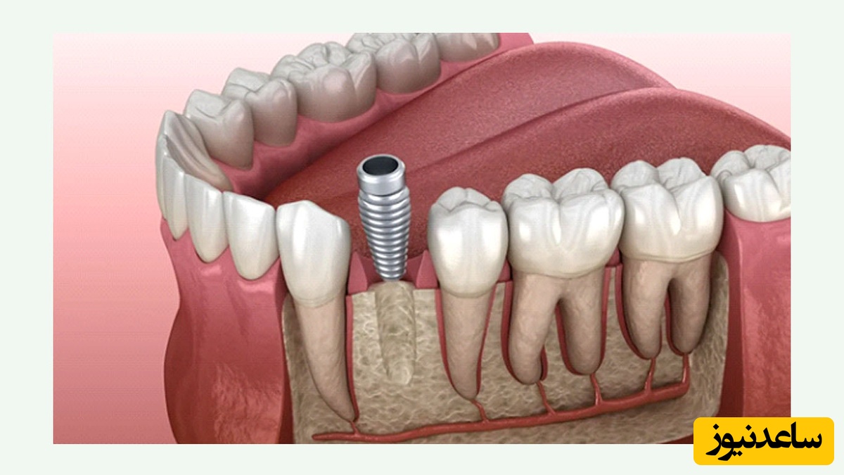 دلایل لق شدن ایمپلنت