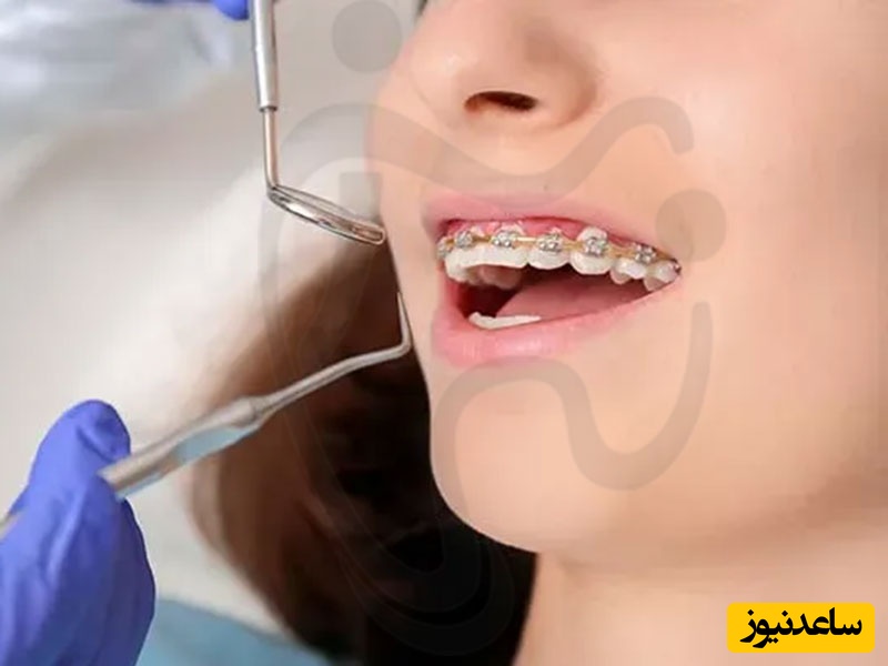 آیا ارتودنسی باعث عفونت دندان می شود؟