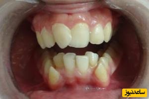  برای درمان نامرتبی دندان‌ها چکار کنیم ؟
