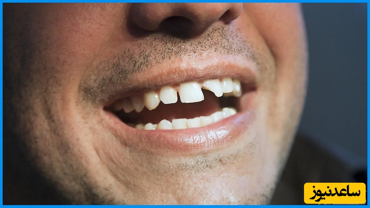 بعد از شکسته شدن دندان جلو چه کار کنیم؟
