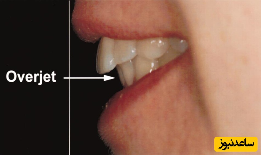 اگر اورجت درمان نشود چه مشکلاتی به بار می آورد؟