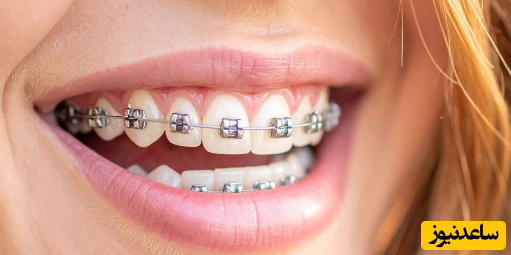 نکات مهم استفاده از کش ارتودنسی که باید بدانید!