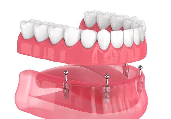 هدف از انجام اوردنچر چیست؟