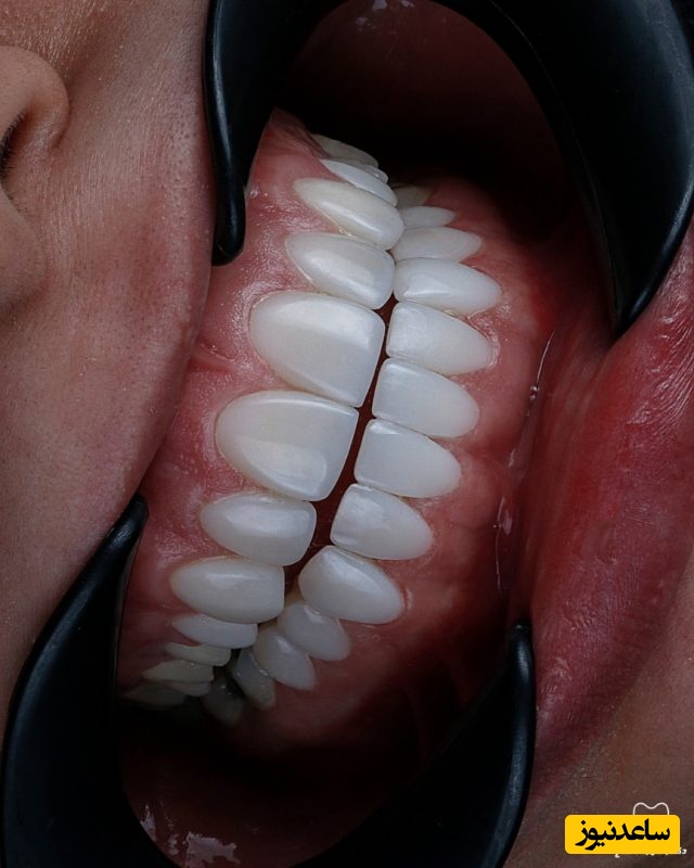 لمینت کامپوزیت دندان چیست؟