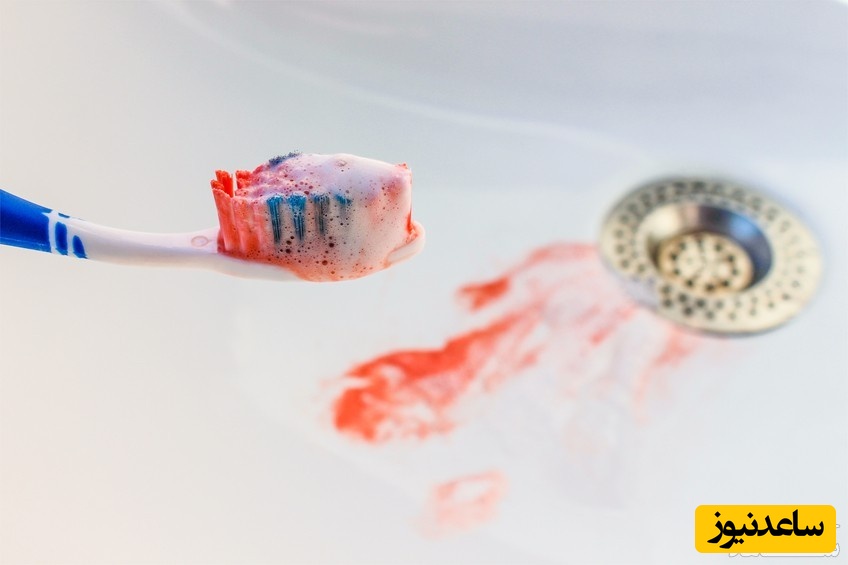 چند درمان خانگی خونریزی لثه