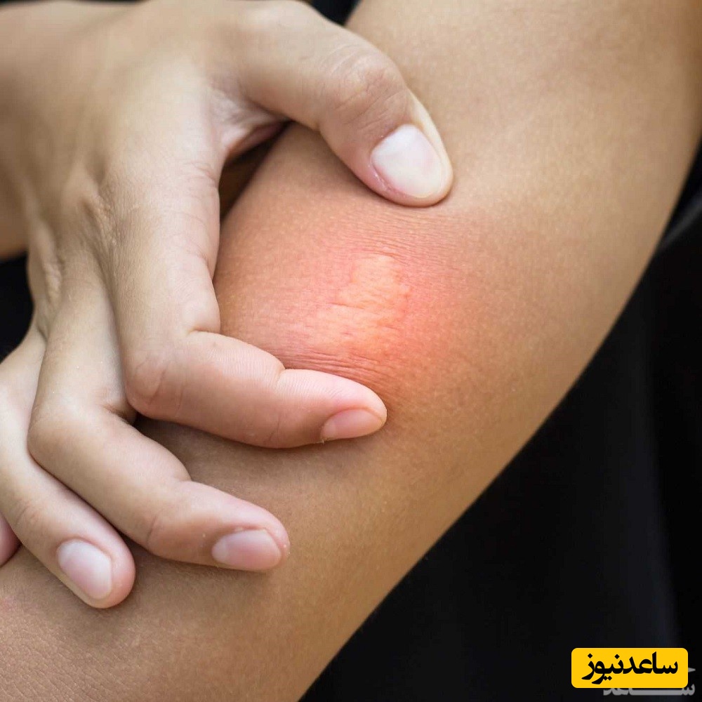 اگر حشره بدن کودک را نیش زد ، چه کار کنیم؟