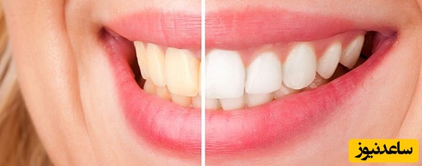 چند روش خانگی برای از بین بردن جرم دندان