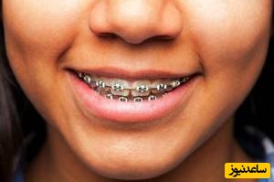 سن مناسب برای ارتودنسی بزرگسالان چه زمانیست؟