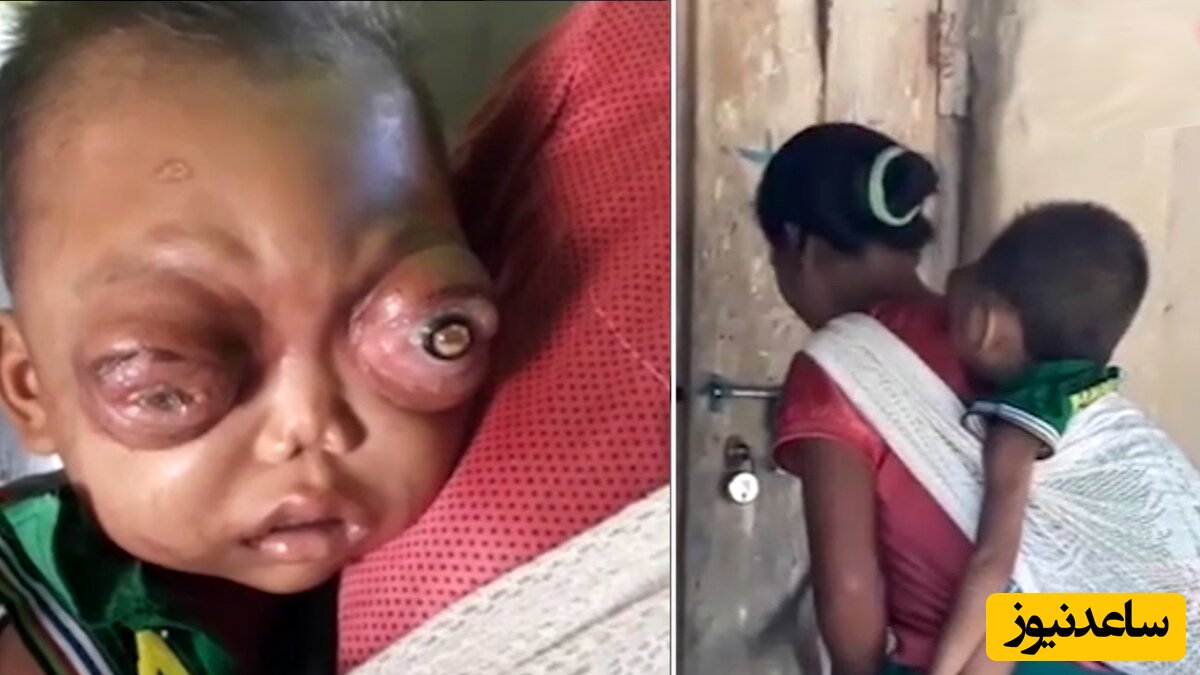 (فیلم) چشمان عجیب الخلقه و ترسناک یک کودک هندی که بادیدنش شوکه می شوید😱😱😱 / خدایا خودت رحم کن!