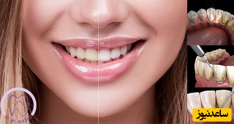 بهترین راهکار های زیبایی دندان چیست؟