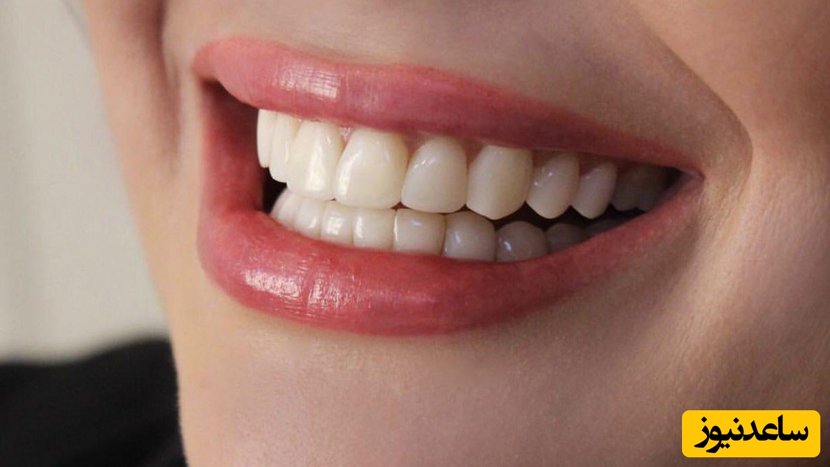 مراحل ترمیم کامپوزیت دندان شکسته چگونه است؟