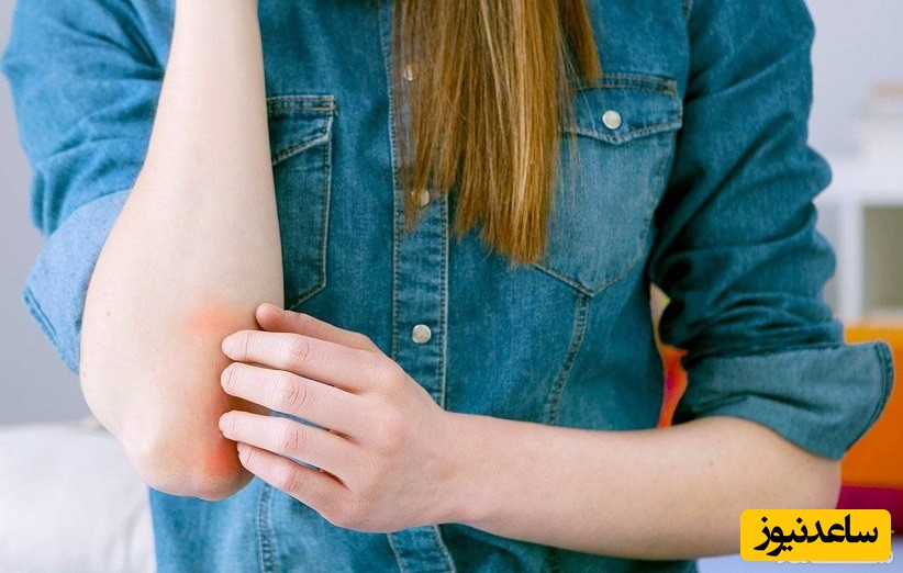 10 درمان خانگی پسوریازیس که باید بدانید