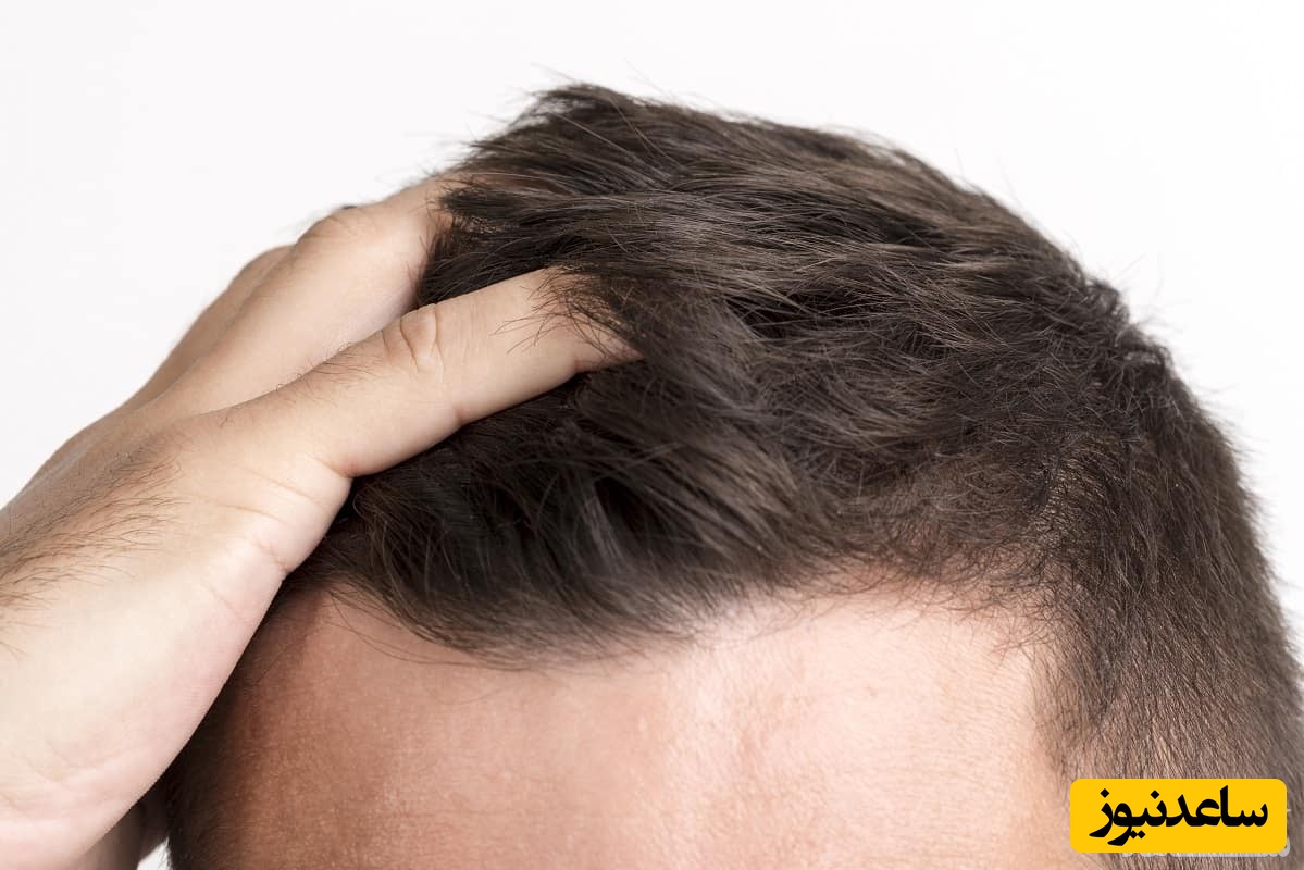 کدام فصل مناسب کاشت موی طبیعی است؟