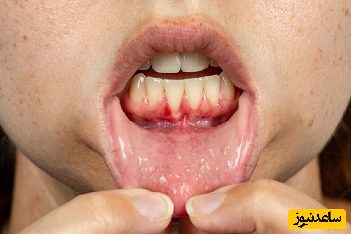 عفونت لثه کودکان چگونه اتفاق می افتد؟