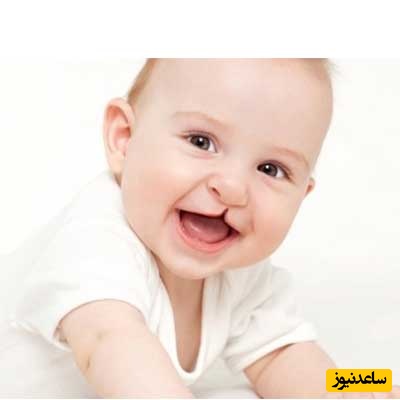 شکاف لب در نوزاد چیست؟