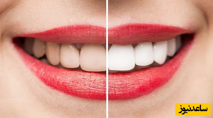 از بین بردن زردی دندان