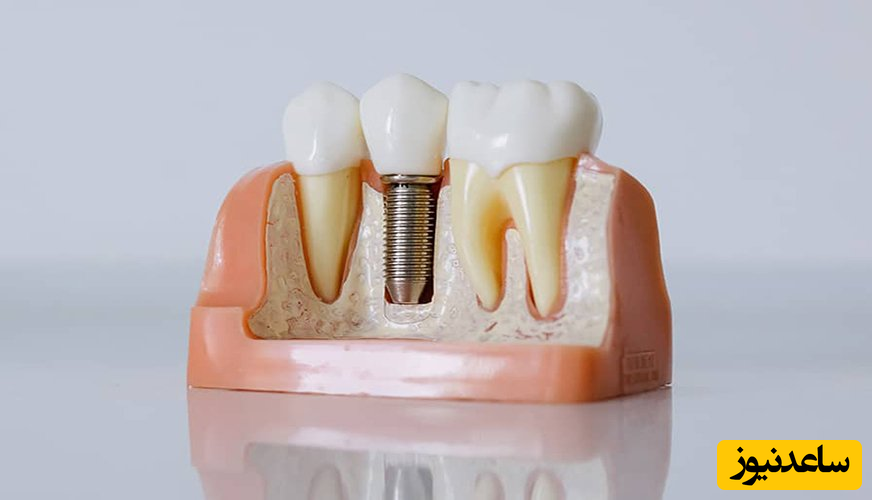 صفر تا صد مراحل ایمپلنت دندان بدانید!
