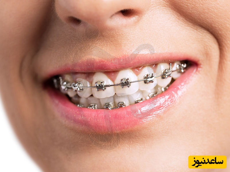 چه زمانی و چگونه باید از کش های ارتودنسی استفاده کنید؟