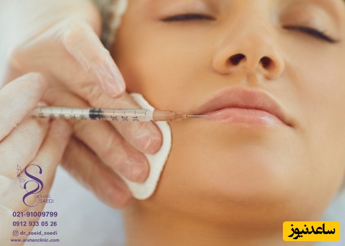 مراقبت های بعد از تزریق ژل لب