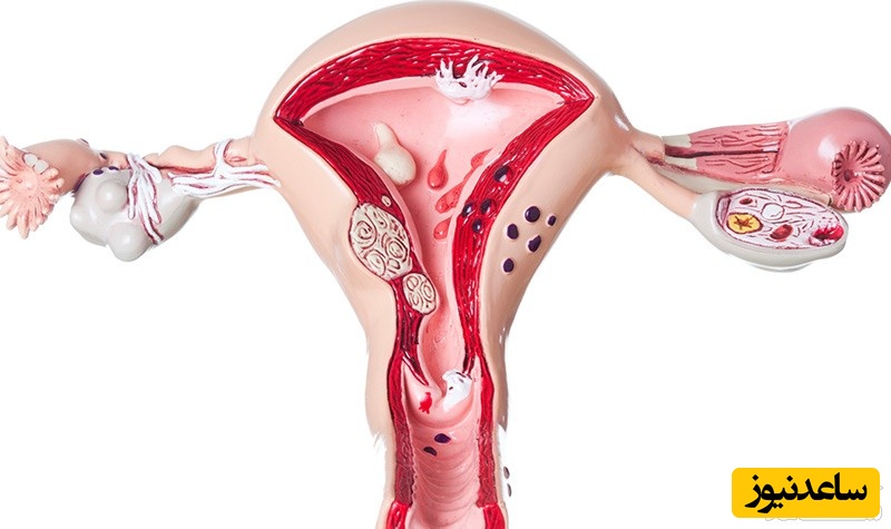 علل کج شدن رحم و تاثیر آن در بارداری