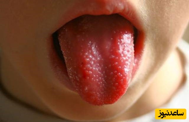 درمان خانگی زخم روی زبان چیست؟