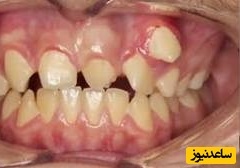 دندان اضافه و نحوه ی ایجاد آن